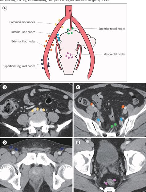 Figure 1 From Nomenclature And Lymphatic Drainage Patterns Of Abdominal