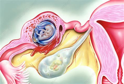 Ectopic Pregnancy Artwork Stock Image C0168736 Science Photo