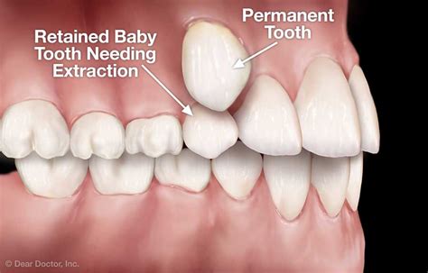 You Must Know Tooth Growing In Front Of Another Tooth 7 Tooth Bantuanbpjs