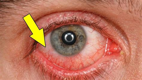 How To Get Rid Of Red Eyes Quickly At Homehome Remedies For Red Eyes