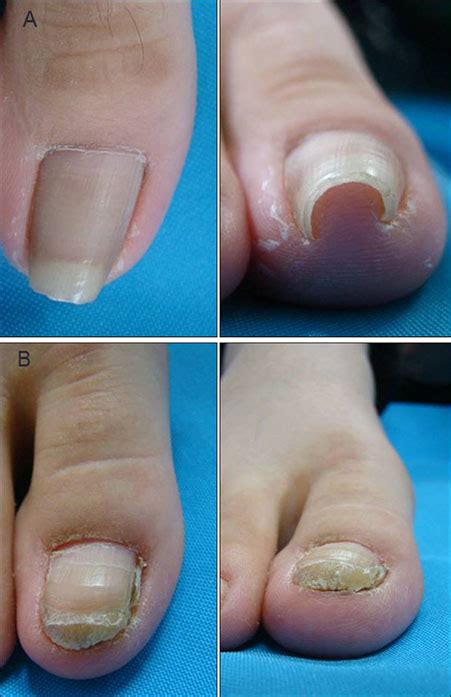 Significance Of Surgery To Correct Anatomical Alterations In Pincer Nails