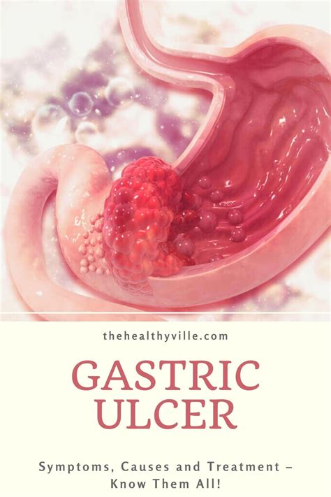 Gastric Ulcer Pathophysiology Hot Sex Picture