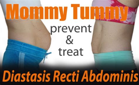 “mommy Tummy” Evidence Based Techniques For Treatment And Prevention
