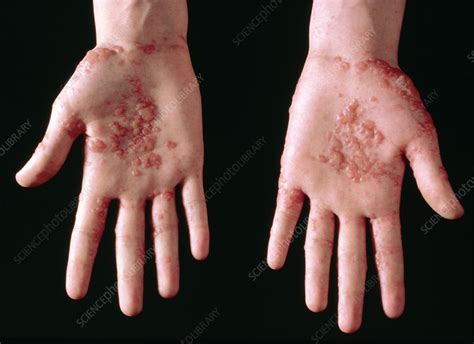 Cutaneous Herpes Simplex Rash On Hand Stock Image M1700120