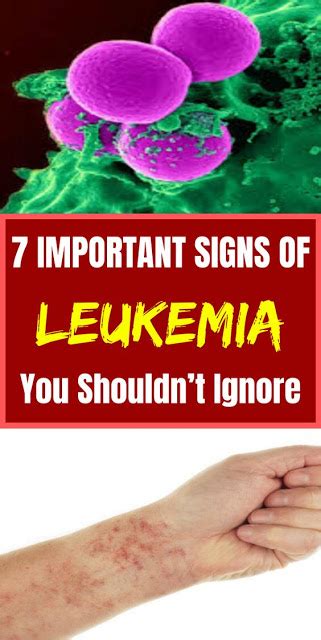 7 Important Signs Of Leukemia You Shouldnt Ignore Medicine003