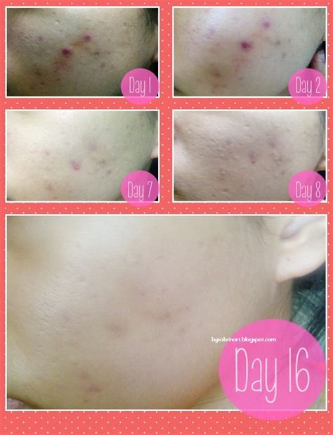 By laurie22, 23 hours ago in scar treatments. Hiruscar Post Acne Gel | VERDICT | Sabrina Tajudin ...