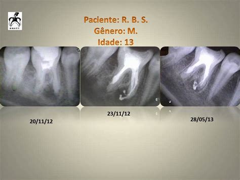 Endodontia Dr Henrique Braitt Tratamento endodôntico de molar com reabsorção interna raiz