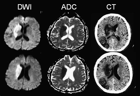 Mr Diffusion Imaging In Ischemic Stroke Neuroimaging Clinics
