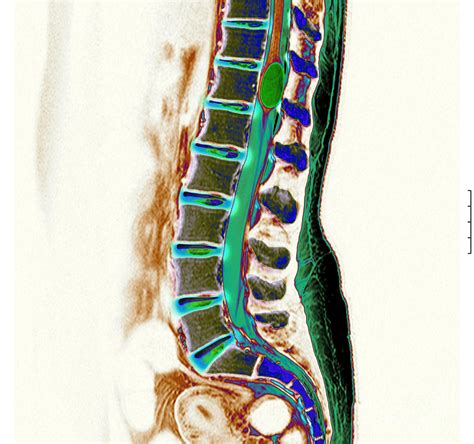 Benign Cyst In The Spine Photograph By Living Art Enterprises Llc Pixels