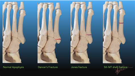 Fractures Of The Fifth Metatarsal Base Uw Emergency Radiology