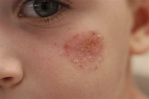 Tiga jenis dermatophyte yang dikenal pasti menyebabkan kurap adalah dari jenis trichophyton, microsporum dan epidermophyton. Kudis Api (Impetigo): Punca, Simptom dan Rawatan - The ...