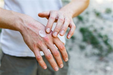 Eczema 101 Everything You Need To Know Rheumatology And Allergy