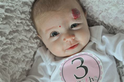 Infant Hemangioma Pictures 54 Photos And Images