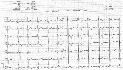 An Electrocardiogram Sinus Rhythm Left Axis Deviation Left Anterior