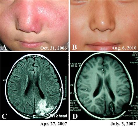 A Patient Case 8 With Cutaneous And Encephalic Balamuthia