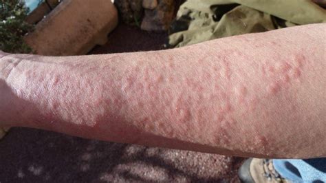 What Does It Mean If You Have These Rashes Tiphero