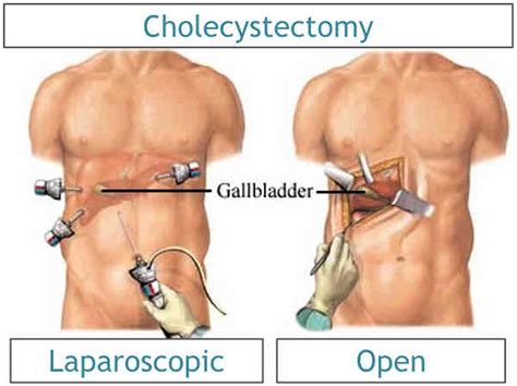 Cholecystectomy Gallbladder Removal Surgery Recovery Side Effects
