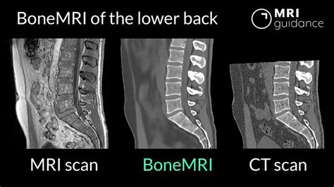 BoneMRI Now Available For Lower Back MRIguidance