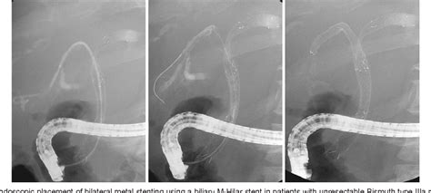 Figure 4 From Endoscopic Stent Placement In The Palliation Of Malignant