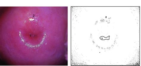 Colposcopy Of The Normal Cervix A Prerequisite To Establishing The