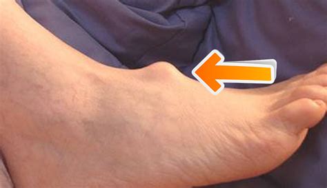 Cyst On Top Of Foot Ganglion Cysts Information Treatments And Remedies
