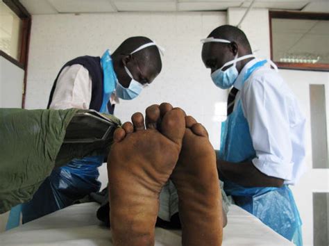 an aids ravaged nation turns to circumcision wbur news