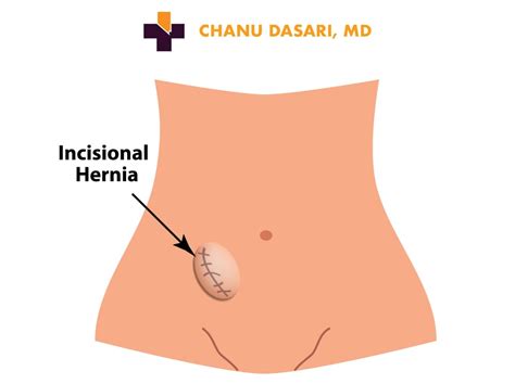 Symptoms of a ventral hernia include: Hernia Repair Specialist | General Surgeon Dr. Chanu Dasari