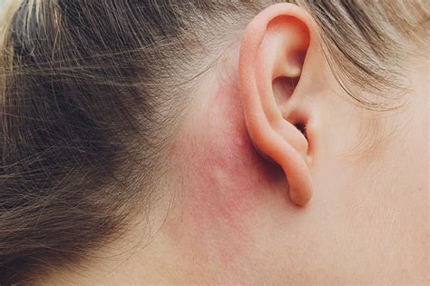 Contact Dermatitis Ear Piercing Ph