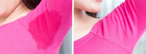 Treat Excessive Sweating And Hyperhidrosis In Surrey Bc Metro Vancouver