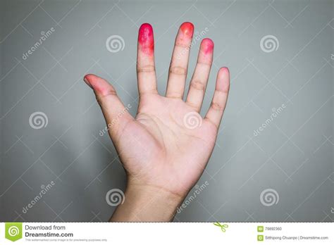 Bloody On The Fingers Stock Photo Image Of Fingers 79892360