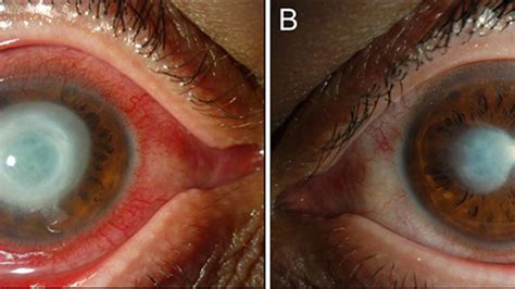 Mistaken Identity The Mysterious Case Of A Corneal Ulcer