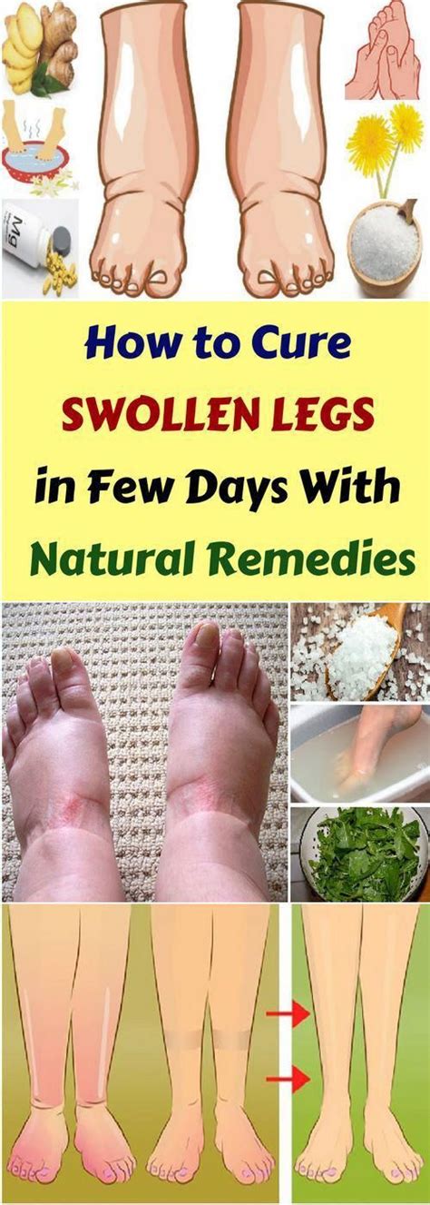Swelling In Legs Home Remedies