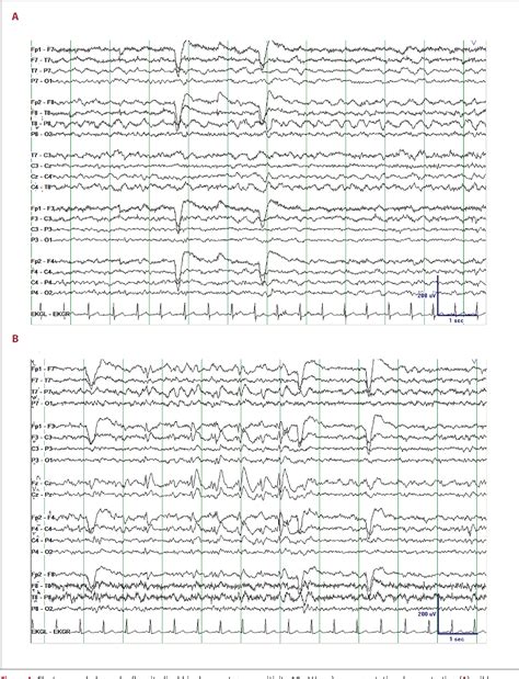 Figure 1 From Seizure And Interictal Electroencephalographic Eeg