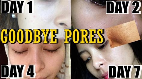 Solusyon Sa Pimples Butlig At Open Pores Clear Skin After Days