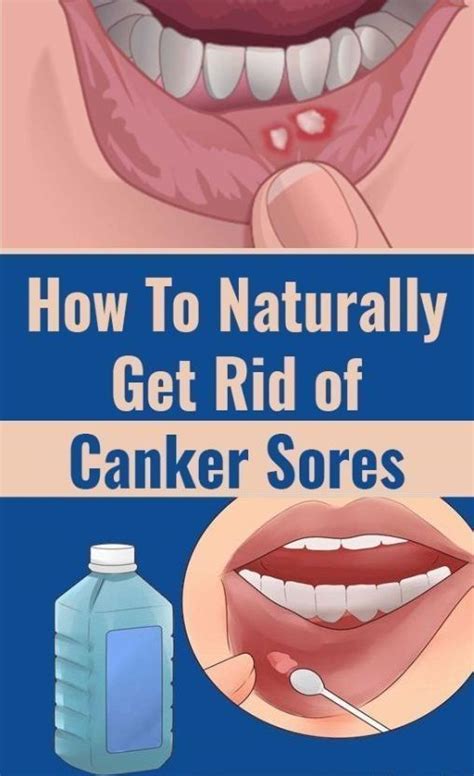 Home Remedies For Canker Sore On Tongue In 2020 Sore In Mouth