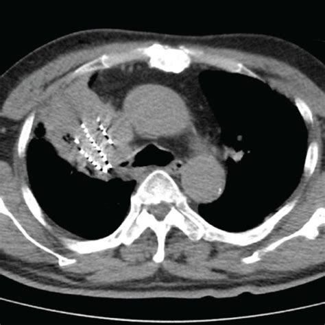 A An Enhanced Ct Scan Of The Chest With A Lump In The Upper Lobes Of