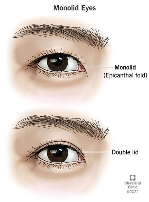 Epicanthal Folds Vs Normal