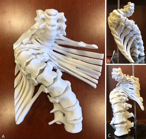 A Case Of Adult α Type Spinal Deformity With Spinal Cord Rotation