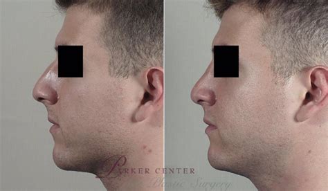 Rhinoplasty Before And After Pictures Case 204 Paramus Nj Parker