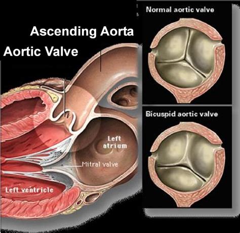 Bicuspid Aortic Valve Stenosis