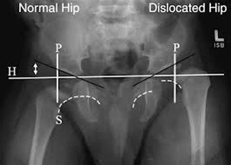 Developmental Dysplasia Of The Hip Radiology Case