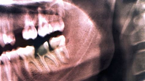 Bbc Earth How Our Ancestors Drilled Rotten Teeth