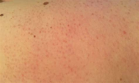 Why You Get Tiny Red Bumps On Your Arms And How To Get Rid