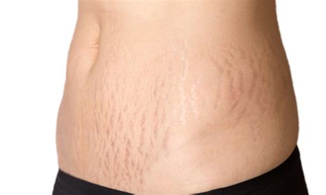 Can Stretch Marks Be Removed With Laser Orange Coast Aesthetics
