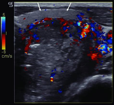 transverse us scan of the cervix shows a large mass with focal areas download scientific