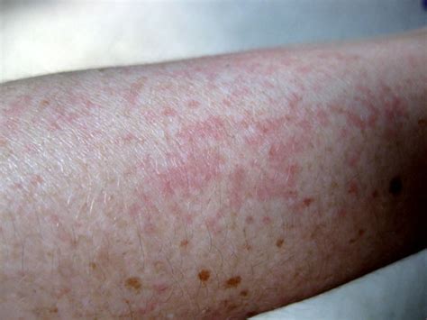 We also have three cases of severe skin rashes, and many villagers suffer with sleep problems, headaches, dizziness and problems with low immune we have had our rashes of hooliganism and trespassing, but it is on the wane, largely because of the system of employing voluntary wardens. Rashes Caused by Touching Zucchini Plants | POPSUGAR Fitness