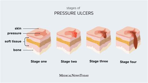 Stages Of Pressure Ulcers Treatment And Recovery