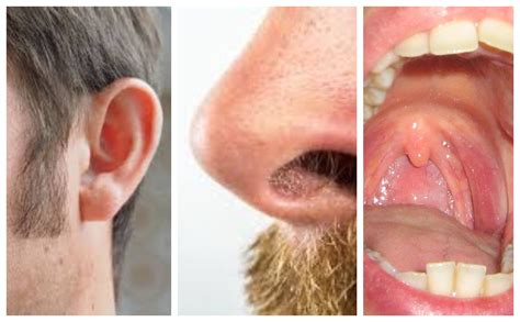Ear Nose And Throat Conditions Pictures
