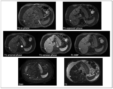 Diagnostics Free Full Text Mri Appearance Of Focal Lesions In Liver