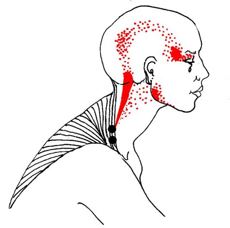 86 Best Occipital Neuralgia Images On Pinterest